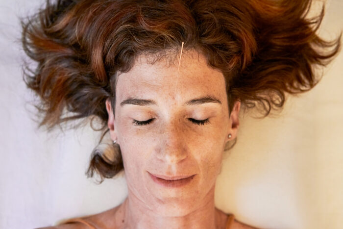 acupuncture for stress